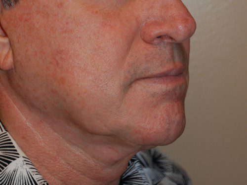 Facelift Before Patient 2