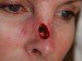 Skin Cancer Reconstruction Before Patient Thumbnail 2