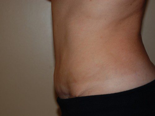 Tummy Tuck After Patient 4