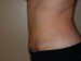 Tummy Tuck After Patient Thumbnail 4