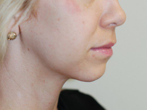 Neck Liposuction After Patient 2