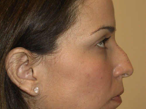 Rhinoplasty Before Patient 2