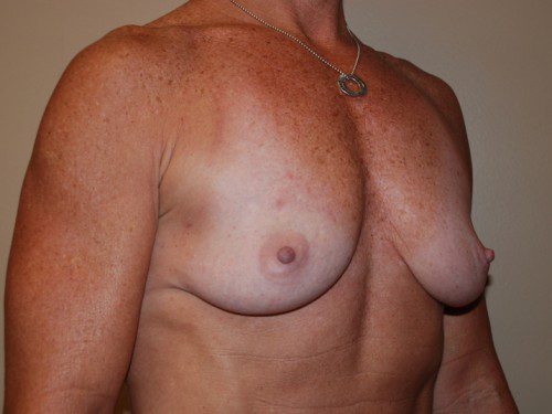 Breast Reconstruction Immediate Implant Before Patient 2