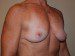 Breast Reconstruction Immediate Implant Before Patient Thumbnail 2