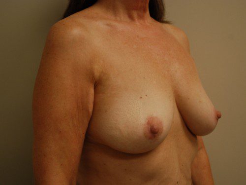 Breast Reconstruction Tissue Expanders Before Patient 2