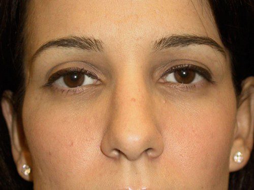 Rhinoplasty After Patient 1