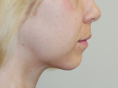 Neck Liposuction After Patient 5