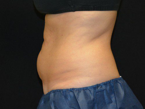 Coolsculpting Before Patient 3