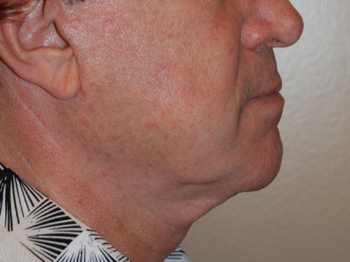 Facelift Before Patient 4