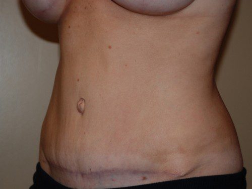 Tummy Tuck After Patient 2