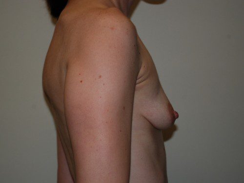 Breast Revision Before Patient 4