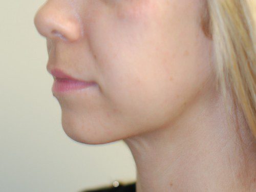 Neck Liposuction After Patient 3