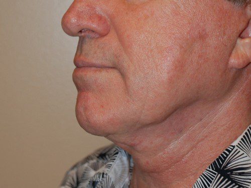 Facelift Before Patient 3