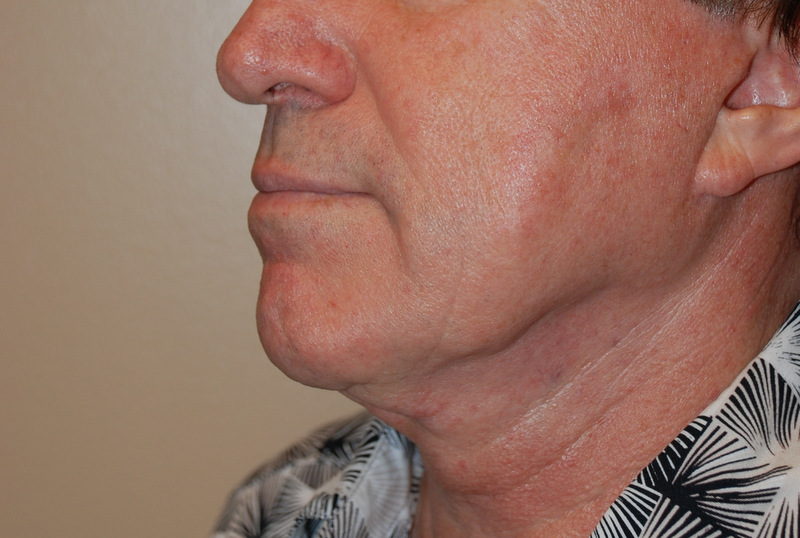 Before and after pictures of a male facelift