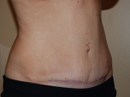 Tummy Tuck After Patient 3