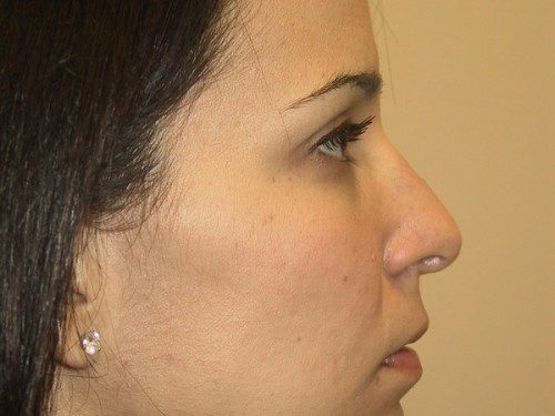 Rhinoplasty After Patient 2