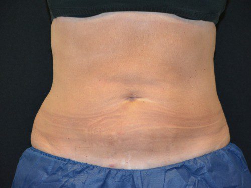 Coolsculpting After Patient 1