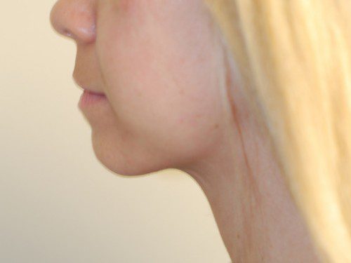 Neck Liposuction After Patient 4