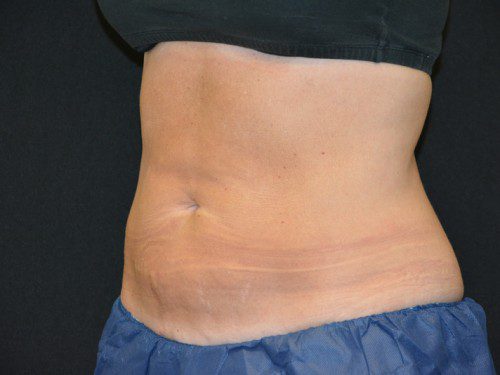 Coolsculpting After Patient 2