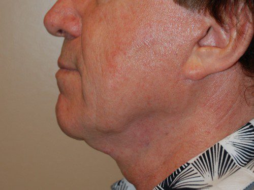 Facelift Before Patient 5