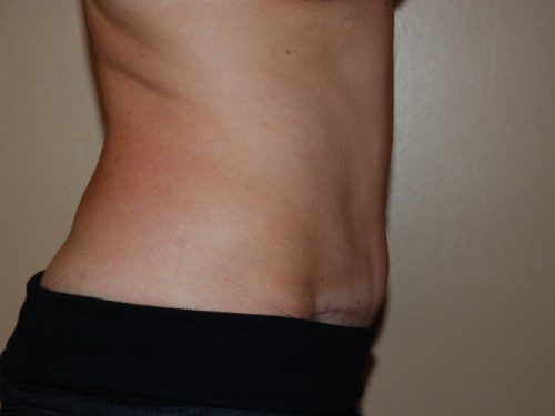 Tummy Tuck After Patient 5