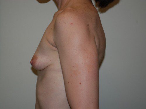 Breast Revision Before Patient 5