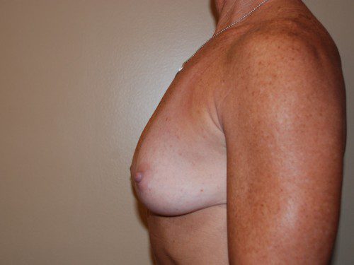 Breast Reconstruction Immediate Implant Before Patient 5