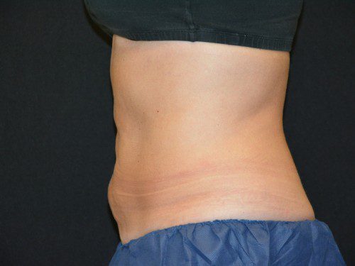 Coolsculpting After Patient 3