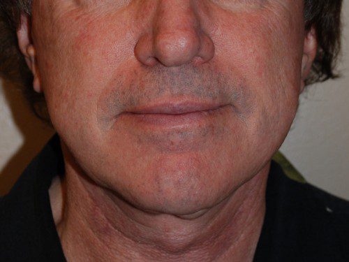 Facelift After Patient 1