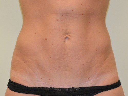 Mini Tummy Tuck After Patient 1