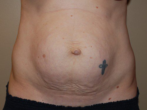 Tummy Tuck Before Patient 1