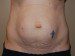 Tummy Tuck Before Patient Thumbnail 1