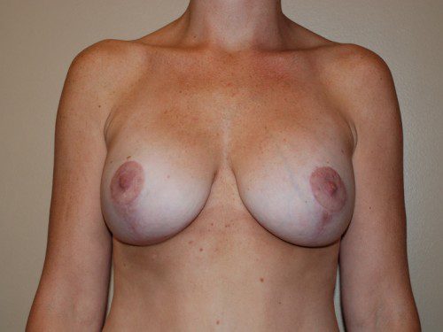 Breast Augmentation w/Lift After Patient 1