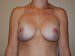 Breast Augmentation w/Lift After Patient Thumbnail 1