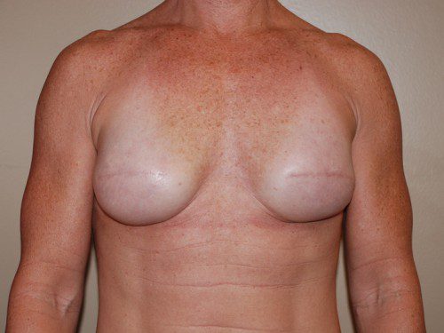 Breast Reconstruction Immediate Implant After Patient 1