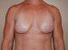 Breast Reconstruction Immediate Implant After Patient Thumbnail 1