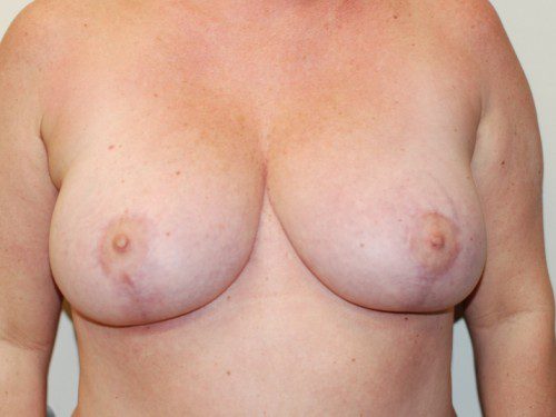 Breast Reduction After Patient 1