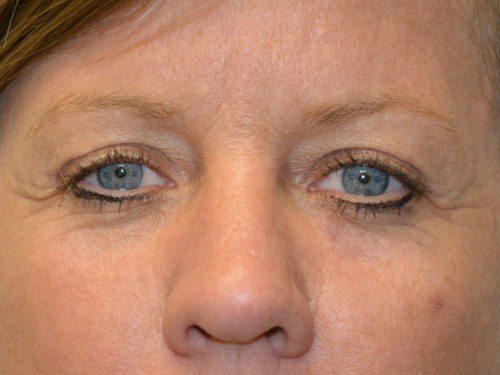 Brow Lift After Patient 1