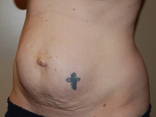 Tummy Tuck Before Patient 2