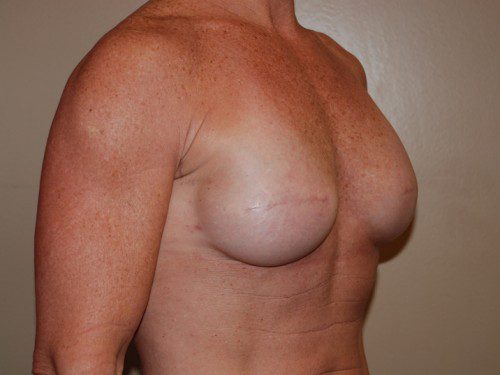 Breast Reconstruction Immediate Implant After Patient 2