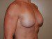 Breast Reconstruction Immediate Implant After Patient Thumbnail 2