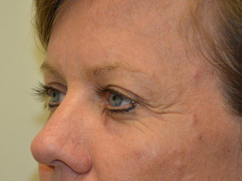 Brow Lift After Patient 2