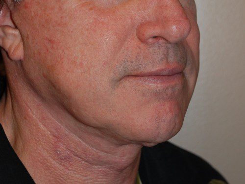 Facelift After Patient 2