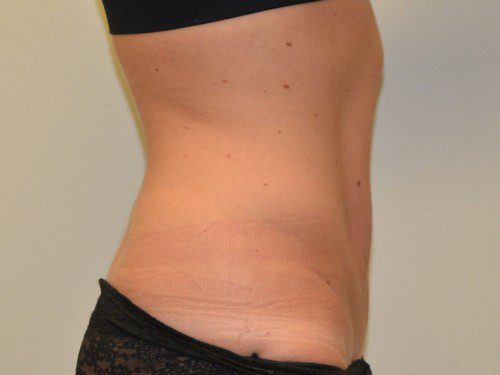 Mini Tummy Tuck After Patient 3