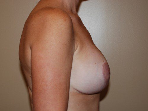 Breast Augmentation w/Lift After Patient 4