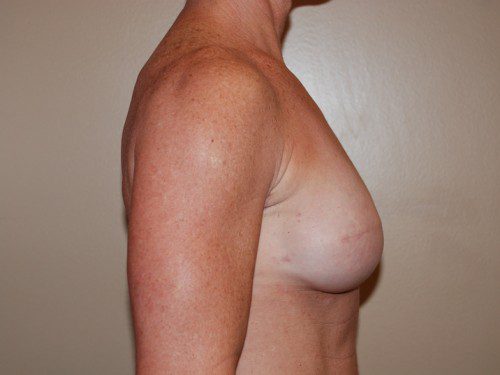 Breast Reconstruction Immediate Implant After Patient 4
