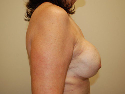 Breast Reconstruction Tissue Expanders After Patient 4