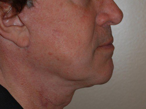 Facelift After Patient 4