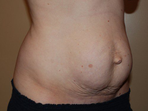 Tummy Tuck Before Patient 3