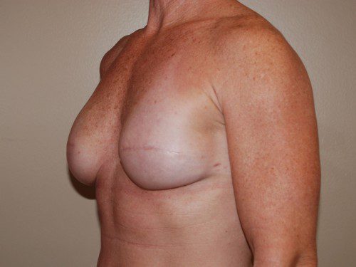 Breast Reconstruction Immediate Implant After Patient 3